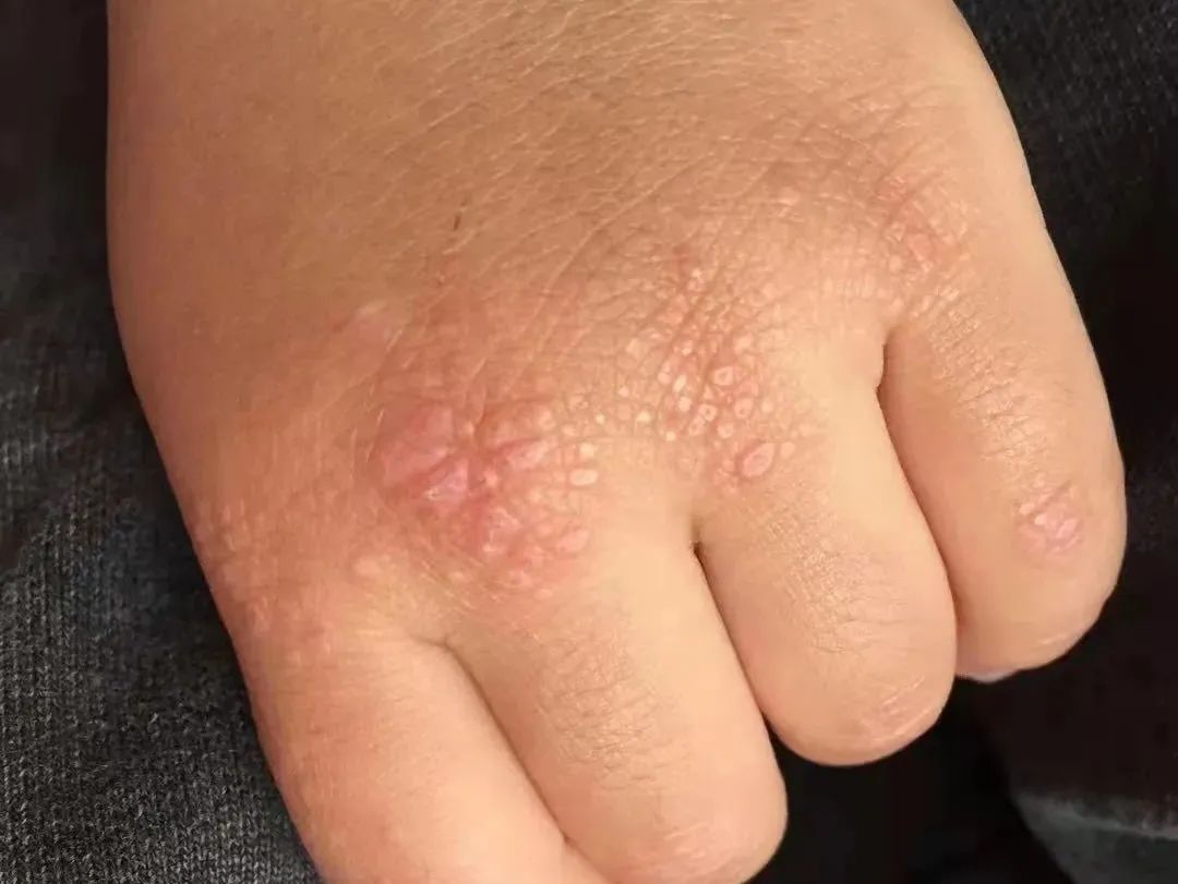 皮肌炎患儿的初步症状(示例).jpg 皮肌炎患儿的初步症状(示例).jpg